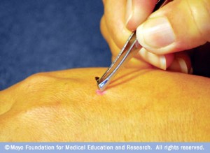 Source: Using tweezers to remove a stinger from a hand