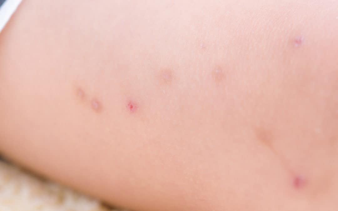 Fleas, Ticks, and Chiggers: What’s the Difference?