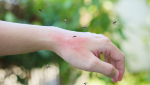 mosquito bites