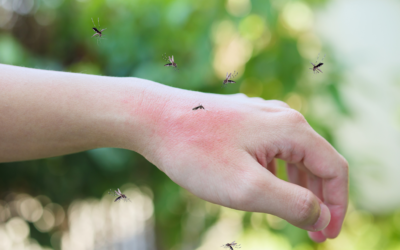 Mosquito Bites: ID, Symptoms, and Treatment