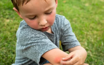 How to Get Rid of Mosquito Bites — Fast Relief and Lasting Prevention