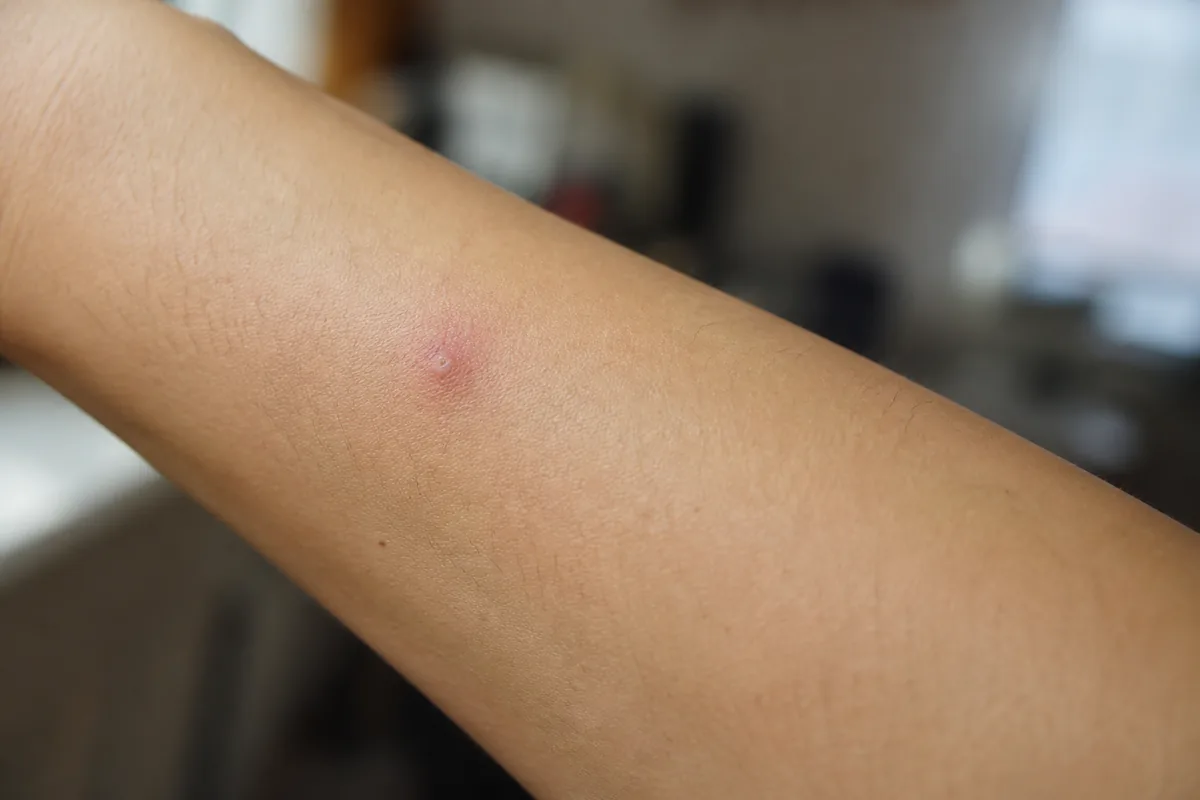 A single raised, reddened mosquito bite on a person's forearm, the typical local reaction Southeast homeowners deal with all season.